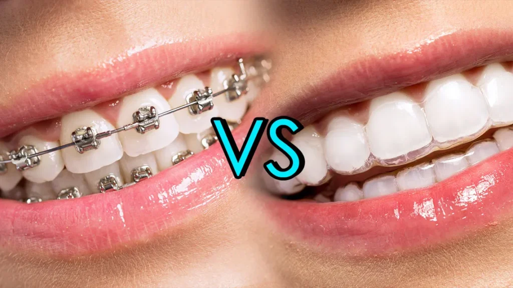 Good Alternative to Metal Braces