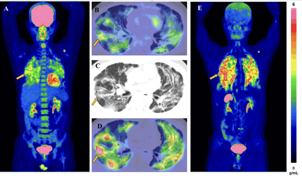 FAPI-PET Imaging