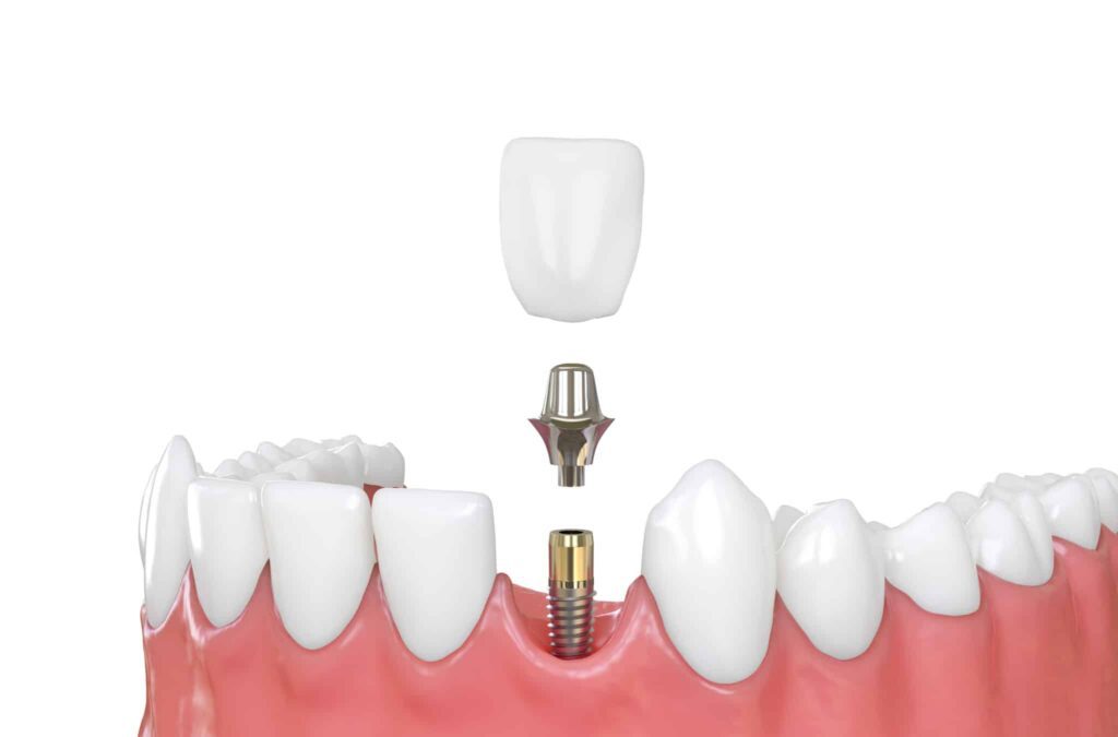 Dental Implants Brisbane