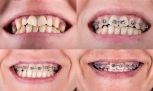 Orthodontic Care