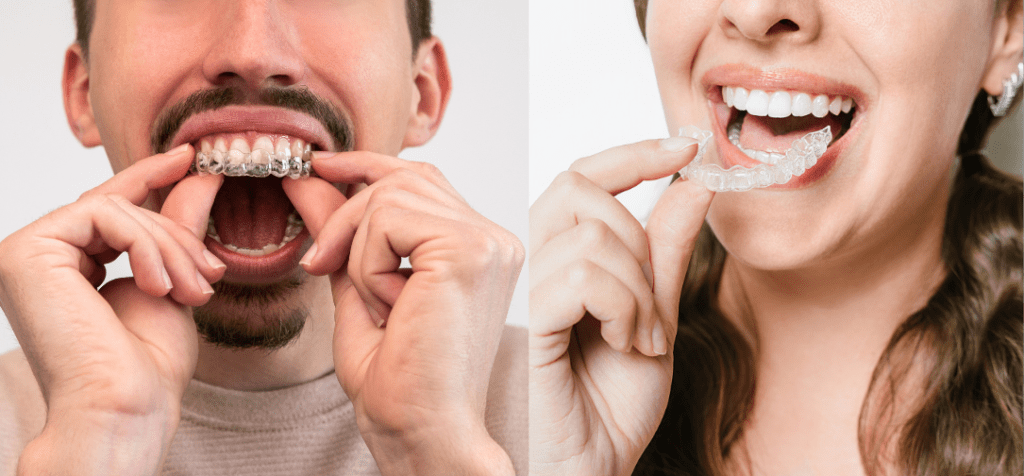 how do clear aligners work science and technology