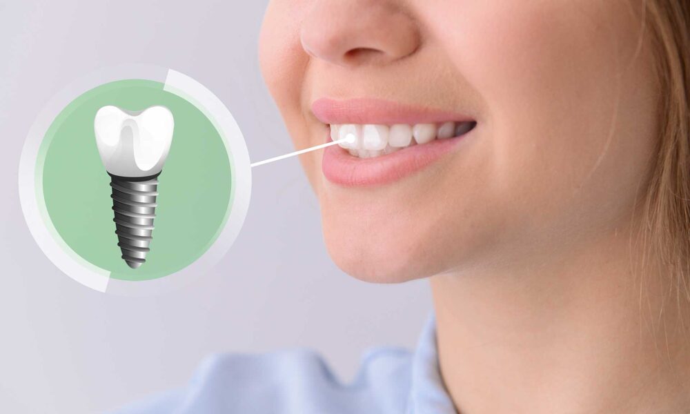 Everything You Need To Know About Dental Implants