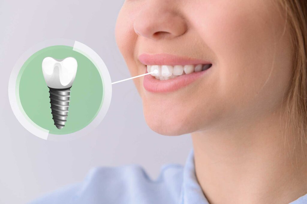 Dental Implants