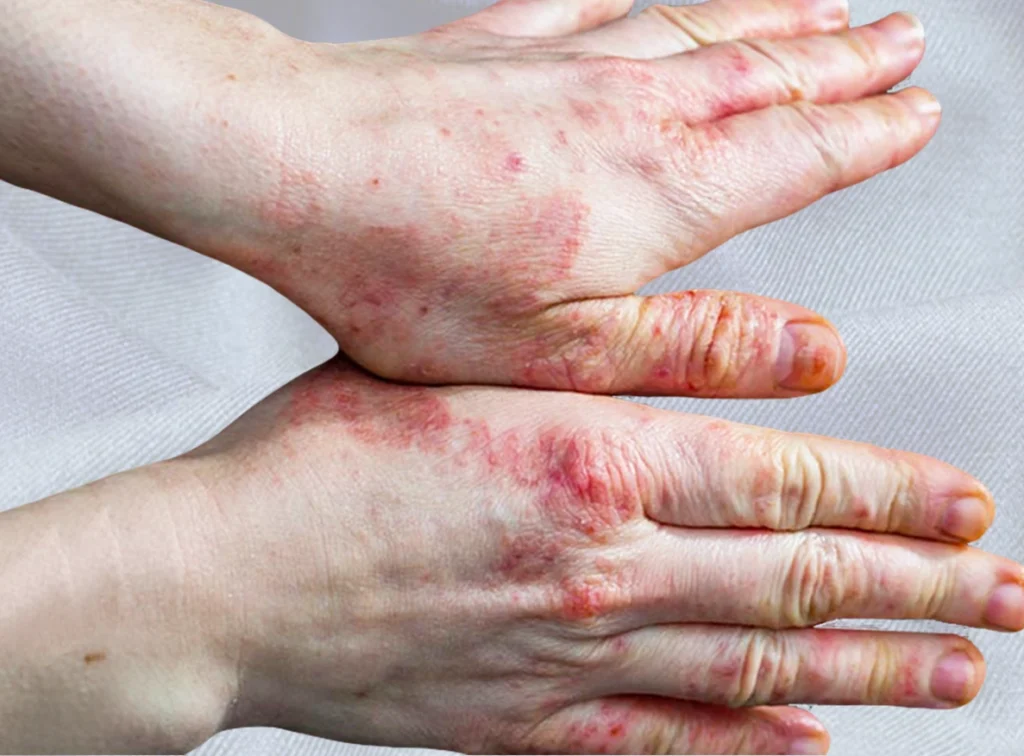 Relief to Long-Term Control: Eczema Treatment