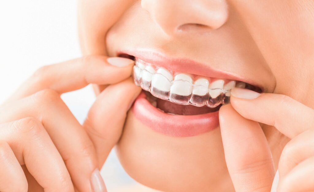 Best Invisalign Dentist NYC
