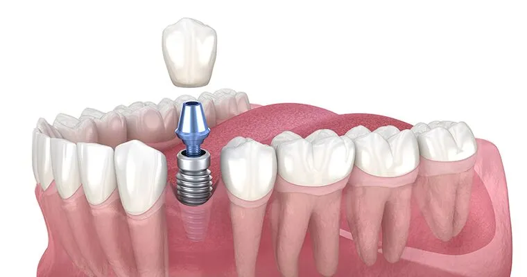 How Long Do Dental Implants Really Last?