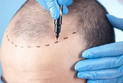 Top Signs You Need a Hair Transplant in Islamabad