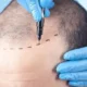 Top Signs You Need a Hair Transplant in Islamabad