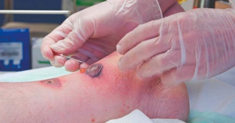 The Myths of Healing: Why “Air It Out” Is Bad Advice