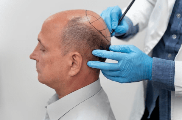 Regain Confidence with Hair Transplantation