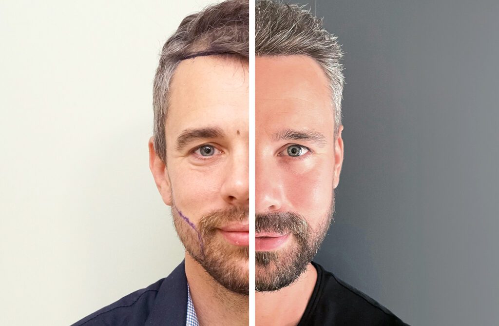 Hair Restoration