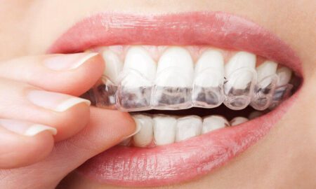 Clear Braces for Adults