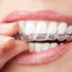Clear Braces for Adults