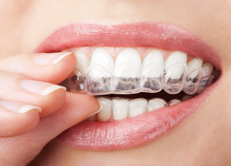 Invisalign Near Me: heldere beugels voor volwassenen