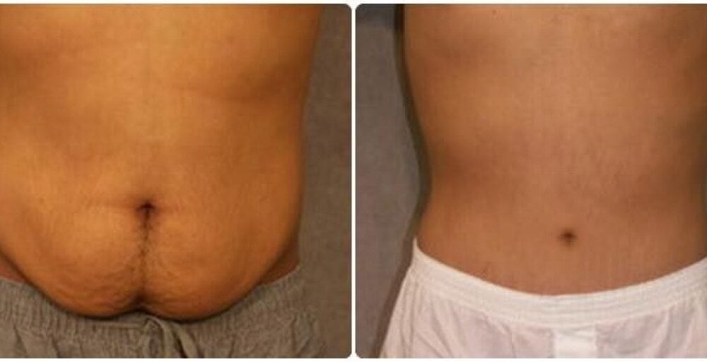 Wat is inbegrepen in de buikwandcorrectie-pakketten in Thailand?