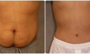 Tummy Tuck Packages in Thailand