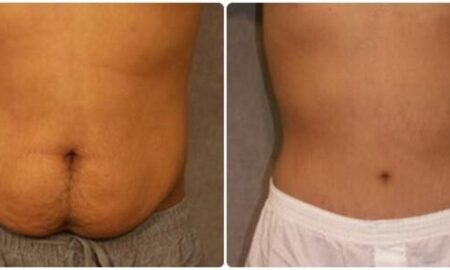 Tummy Tuck Packages in Thailand