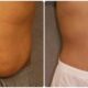 Tummy Tuck Packages in Thailand