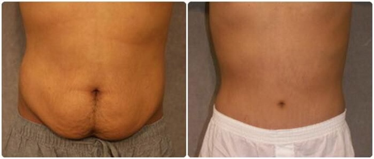 Tummy Tuck Packages in Thailand