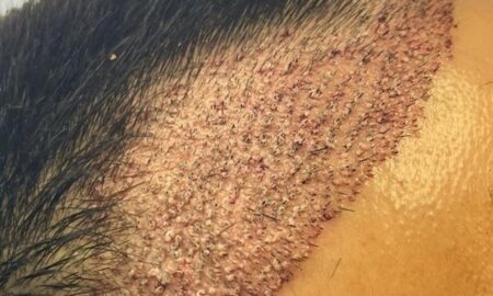 Hair Transplant