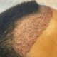 Hair Transplant