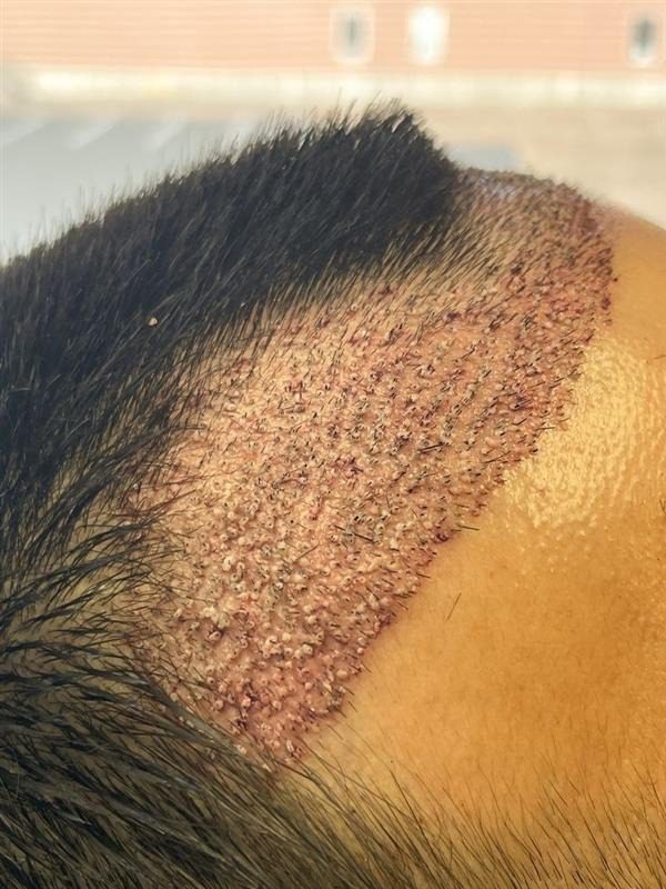 How Hair Transplant Delivers Permanent Results?