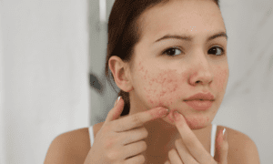 Acne Treatments Chelmsford: Complete Guide to Clearer Skin (2026)