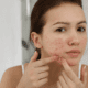 Acne Treatments Chelmsford: Complete Guide to Clearer Skin (2026)