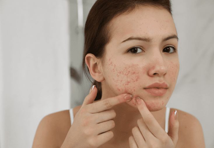 Acne Treatments Chelmsford: Complete Guide to Clearer Skin (2026)