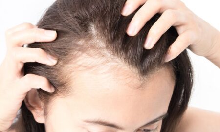 Hormonal Hair loss in PCOS (Women).