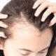 Hormonal Hair loss in PCOS (Women).