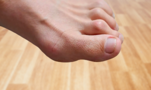 Hammertoe Surgery