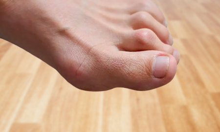 Hammertoe Surgery
