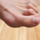 Hammertoe Surgery