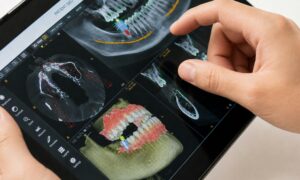 AI Full Mouth Dental Implants