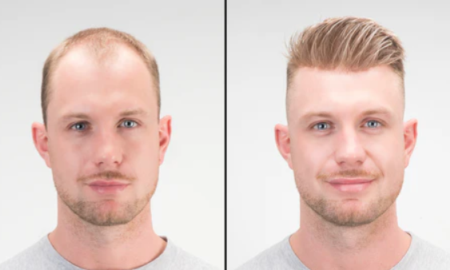 Hair Transplant Risks Revealed: Non-Surgical Alternatives