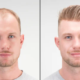 Hair Transplant Risks Revealed: Non-Surgical Alternatives