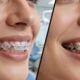 Invisalign Over Braces
