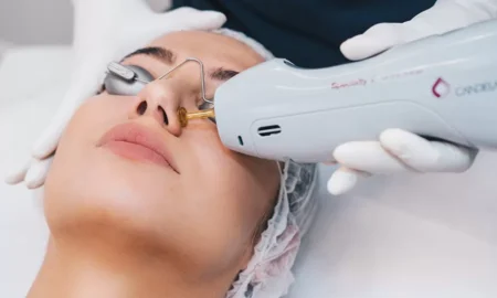 Understanding Spider Vein Removal: A Comprehensive Guide