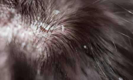 How to Get Rid of Dandruff Fast