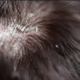 How to Get Rid of Dandruff Fast