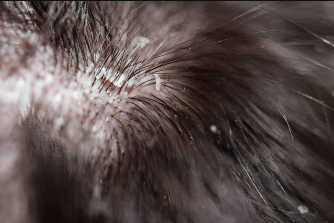 How to Get Rid of Dandruff Fast