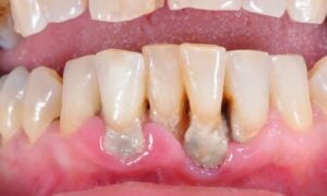 Disease Damages