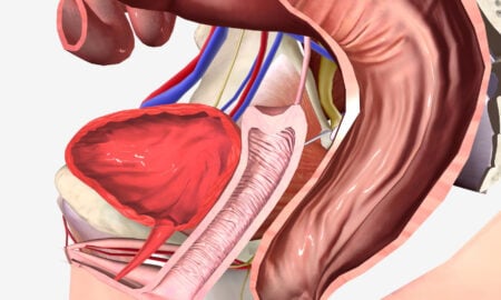 Prostate Artery Embolization in Colorado