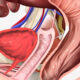 Prostate Artery Embolization in Colorado
