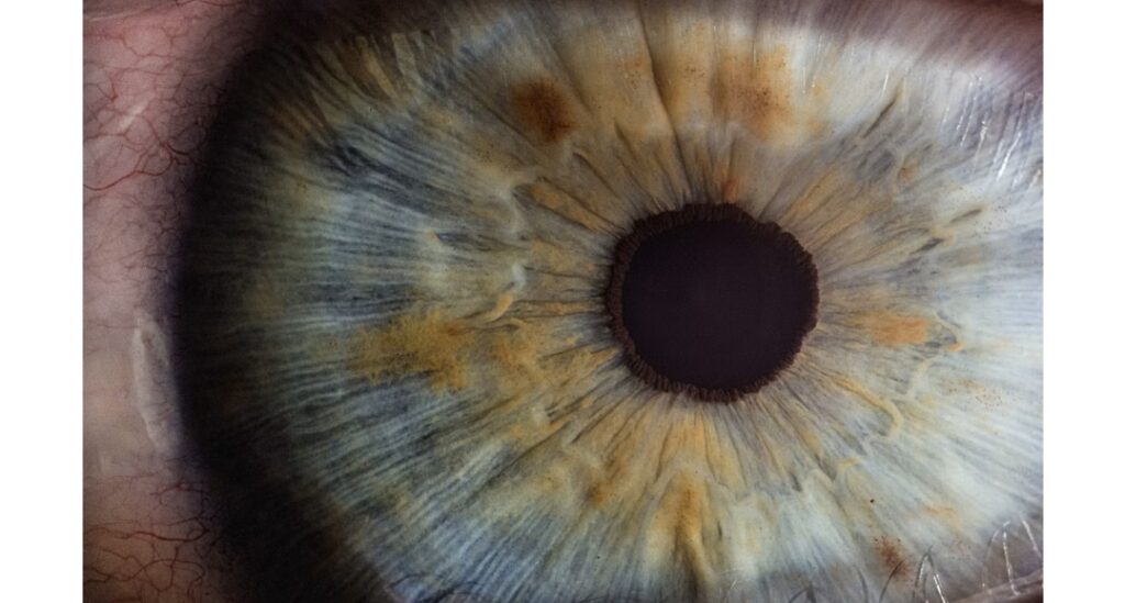 Cataract Care