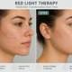 Red Light Therapy